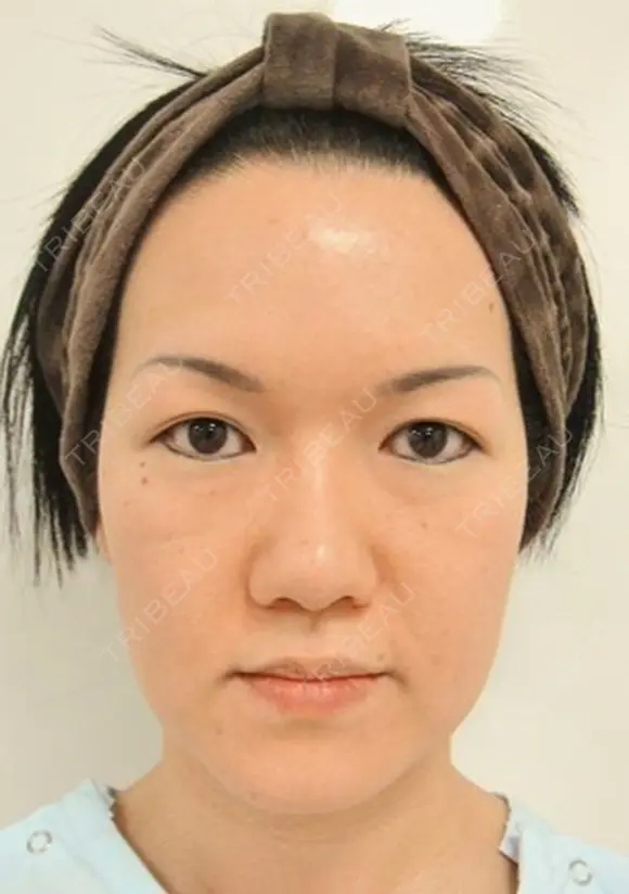 再生医療(全顔面脂肪吸引＆脂肪注入) before画像 メイン用