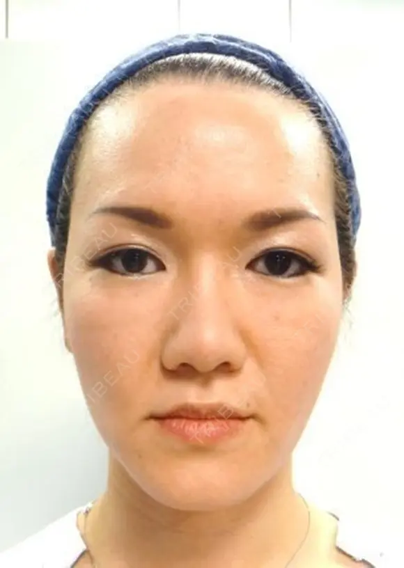 再生医療(全顔面脂肪吸引＆脂肪注入) after画像 メイン用