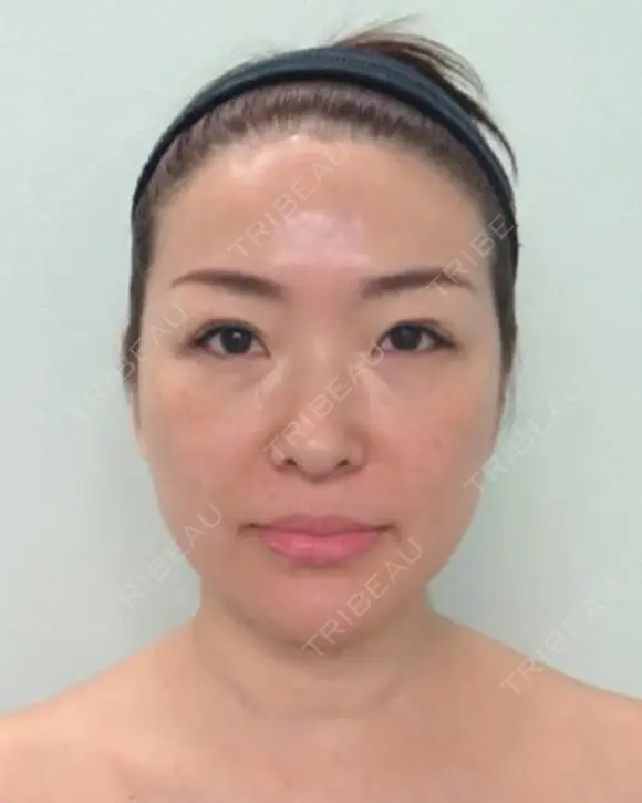 再生医療(顔面脂肪吸引＆脂肪注入) before画像 メイン用
