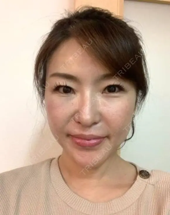 再生医療(顔面脂肪吸引＆脂肪注入) after画像 メイン用