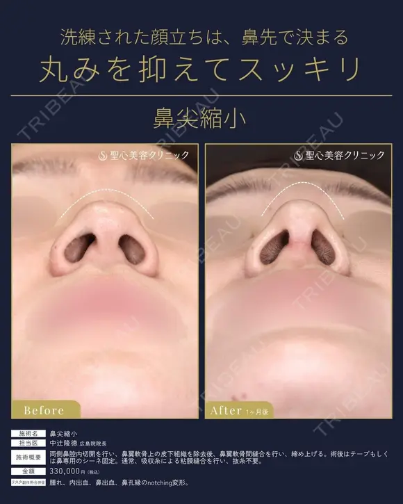 【20代女性・鼻の丸みスッキリ】鼻尖縮小術（1ヶ月後） 30日後 メイン用