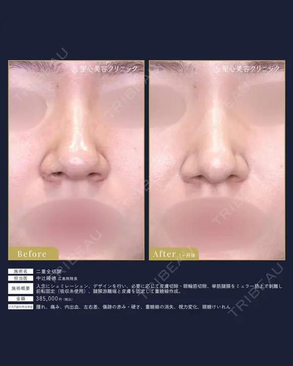 【20代女性・鼻の丸みスッキリ】鼻尖縮小術（1ヶ月後） 30日後 メイン用