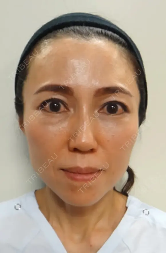 再生医療(顔面脂肪注入)+埋没 after画像 メイン用