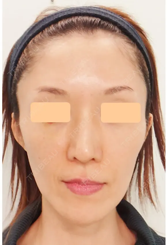 再生医療(顔面脂肪注入) before画像 メイン用
