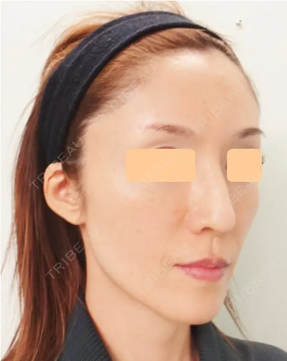 再生医療(顔面脂肪注入) after画像 メイン用
