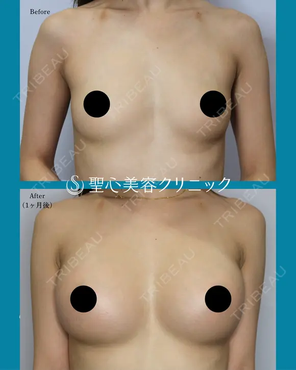 【20代女性】ハイブリット豊胸術（1ヶ月後） before画像 メイン用