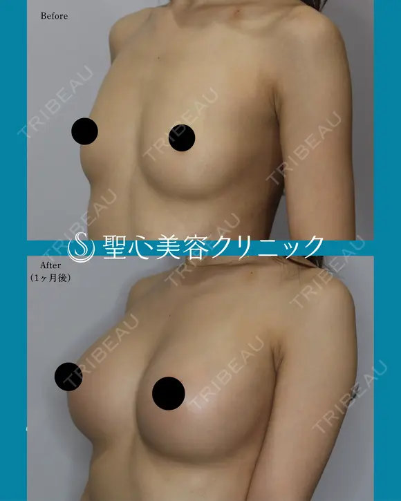 【20代女性】ハイブリット豊胸術（1ヶ月後） 30日後 メイン用