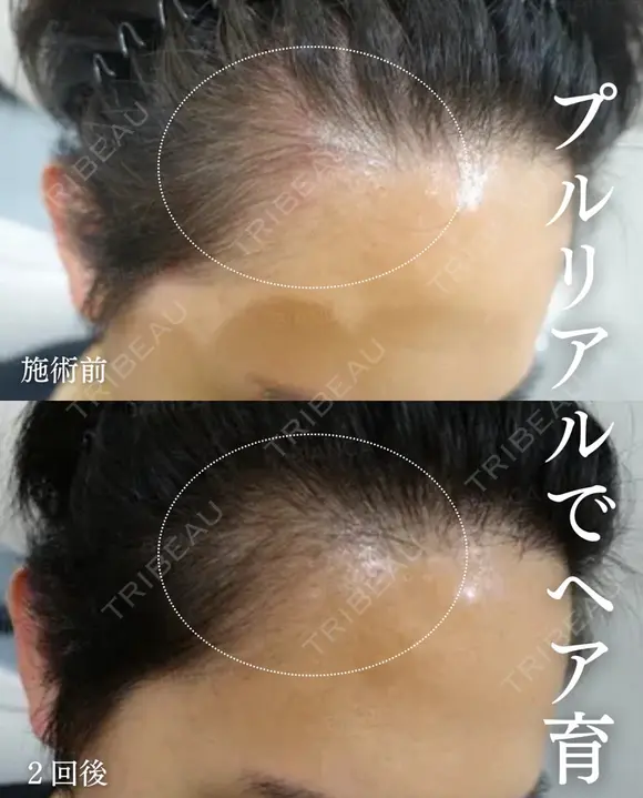 プルリアルヘアデンシティ after画像 メイン用