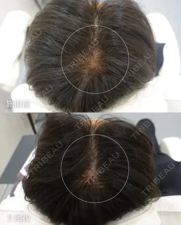 プルリアルヘアデンシティ after画像 メイン用