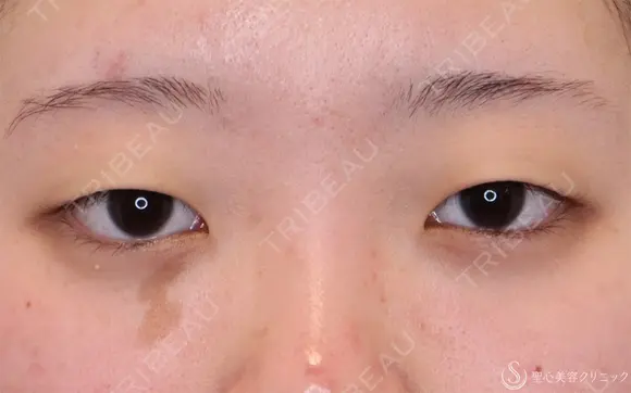 【10代女性・自然な目元に】二重埋没法：ダブルノット法（1ヶ月後） before画像 メイン用