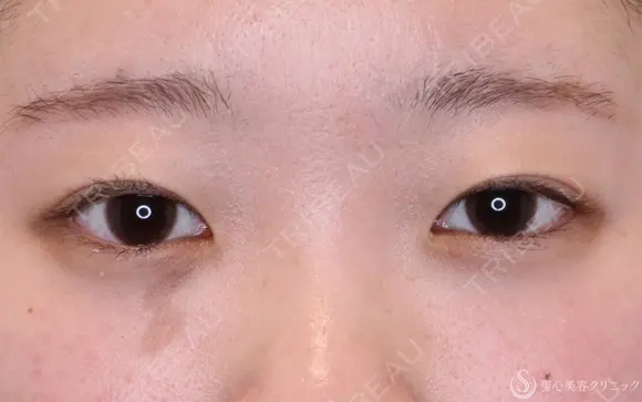 【10代女性・自然な目元に】二重埋没法：ダブルノット法（1ヶ月後） 30日後 メイン用