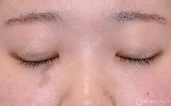 【10代女性・自然な目元に】二重埋没法：ダブルノット法（1ヶ月後） 30日後 メイン用