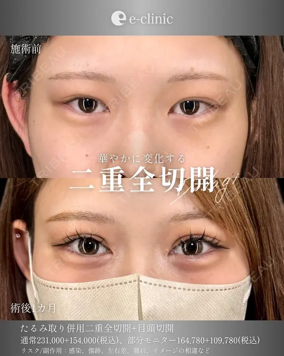 二重全切開 after画像 メイン用