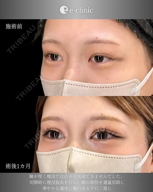 二重全切開 before画像 メイン用
