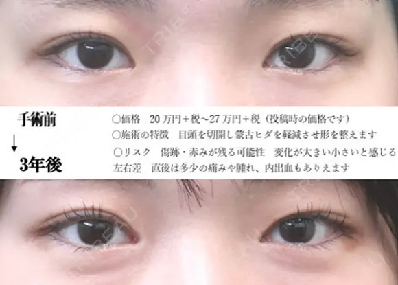 目頭切開法 before画像 メイン用
