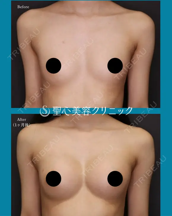 【20代女性】バッグによる豊胸術（MotivaErgonomix2 180cc）（3ヶ月後） before画像 メイン用