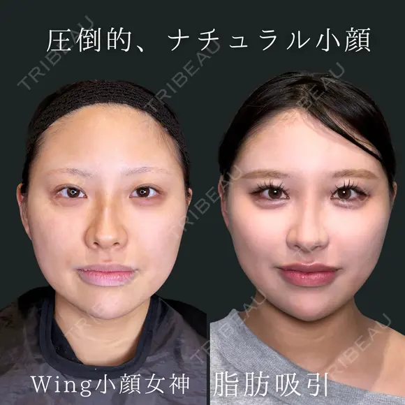 Wing小顔女神脂肪吸引 before画像 メイン用