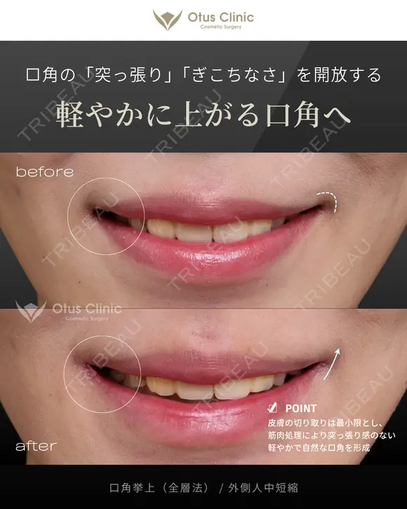 鼻柱切開人中短縮（MIX切開）・鼻翼縮小・鼻翼挙上・貴族組織移植・口角挙上（全層法）・外側人中短縮 before画像 メイン用