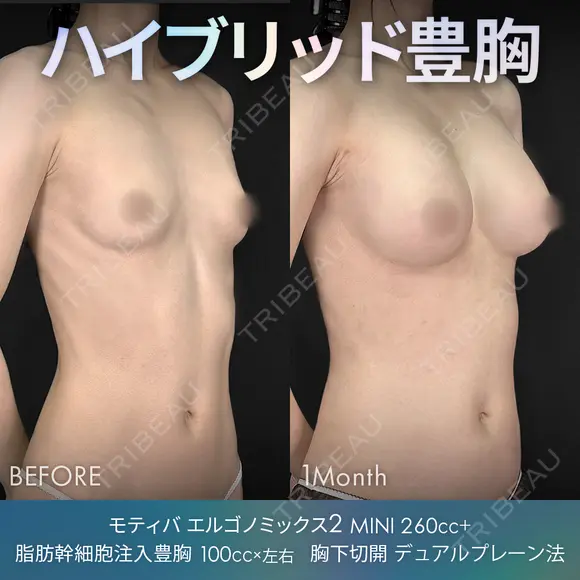 ハイブリッド豊胸（シリコンバッグ豊胸＋脂肪幹細胞注入豊胸）胸下切開 デュアルプレーン法 after画像 メイン用