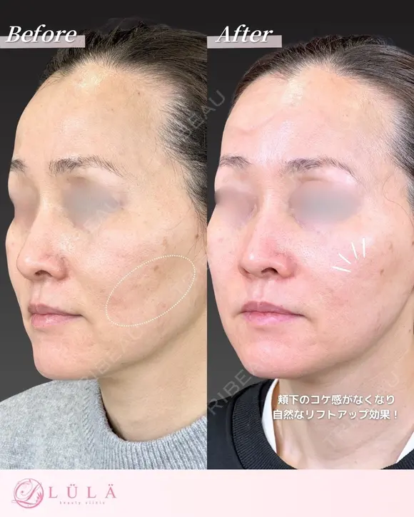 ジャルプロスーパーハイドロ before画像 メイン用