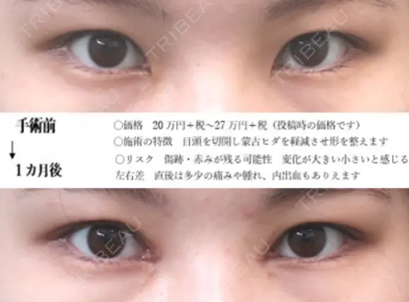 目頭切開法 30日後 メイン用
