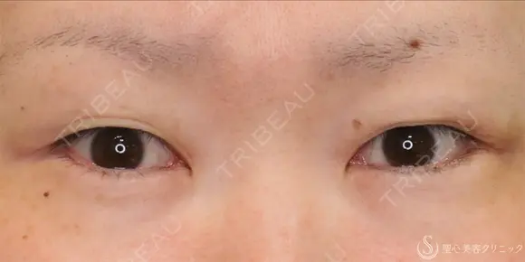 【30代女性・たれ目に】目尻切開法＋グラマラスライン（たれ目）形成切開法（11ヶ月後） 335日後 メイン用