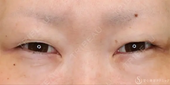 【30代女性・たれ目に】目尻切開法＋グラマラスライン（たれ目）形成切開法（11ヶ月後） before画像 メイン用