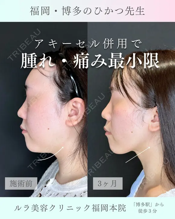 アキーセル併用小顔脂肪吸引　ホホ下＋フェイスライン＋アゴ下＋エラ下 after画像 メイン用