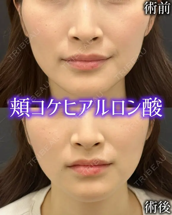 ハートシェイプヒアルロン酸 after画像 メイン用