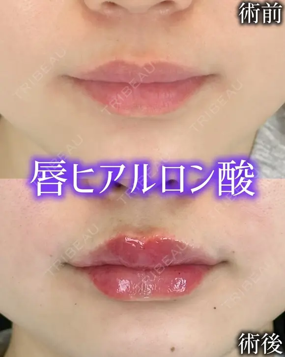 Cカールリップ before画像 メイン用