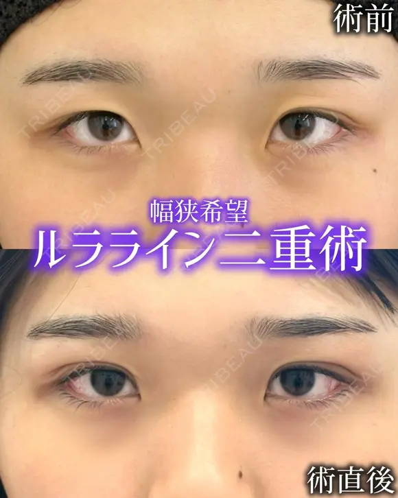 二重埋没（ルラライン２点） before画像 メイン用