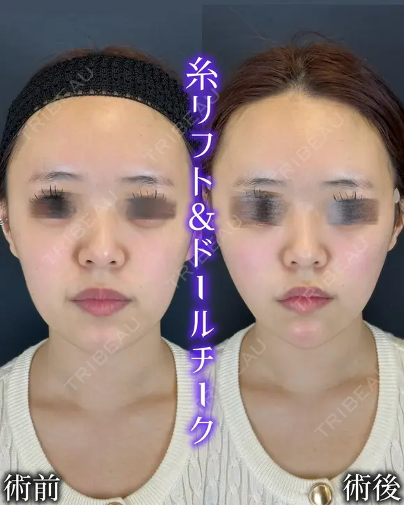 ルラリフト+ドールチーク before画像 メイン用