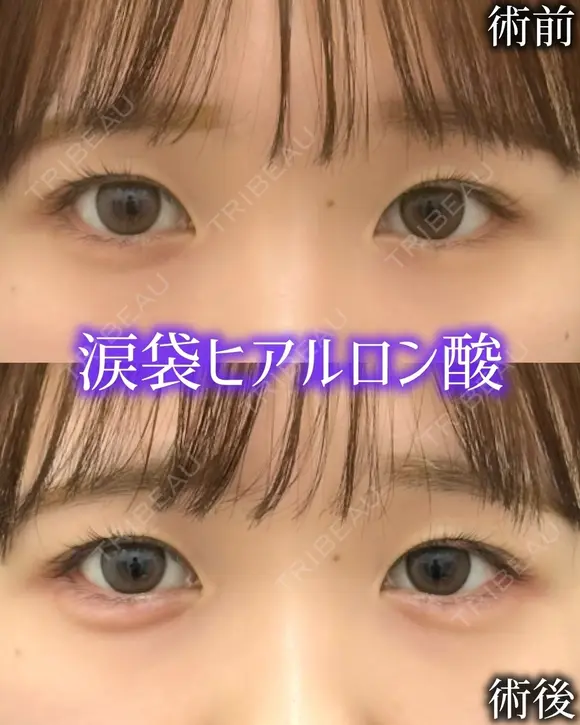 涙袋ヒアルロン酸 0日後 メイン用