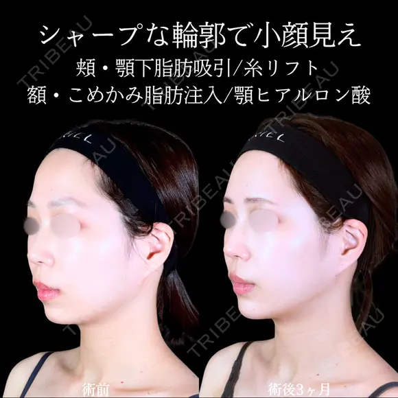 頬・顎下脂肪吸引/糸リフト/額・こめかみ脂肪注入/エラボトックス/顎ヒアルロン酸 before画像 メイン用