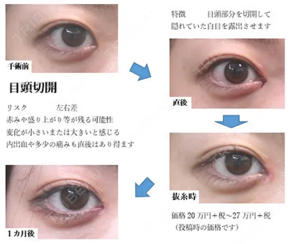 目頭切開法 30日後 メイン用