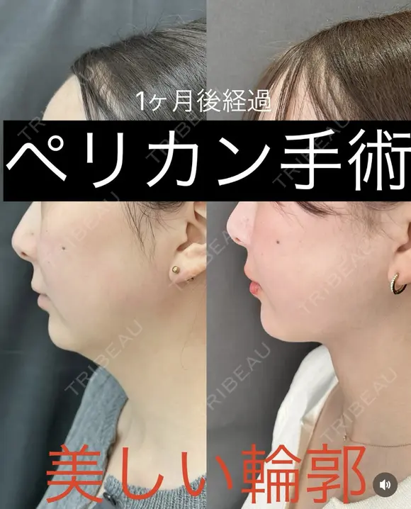 ペリカン手術 before画像 メイン用