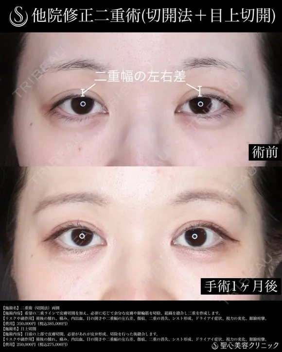【30代女性・1か月後】二重術（切開法）_両側＋目上切開 before画像 メイン用
