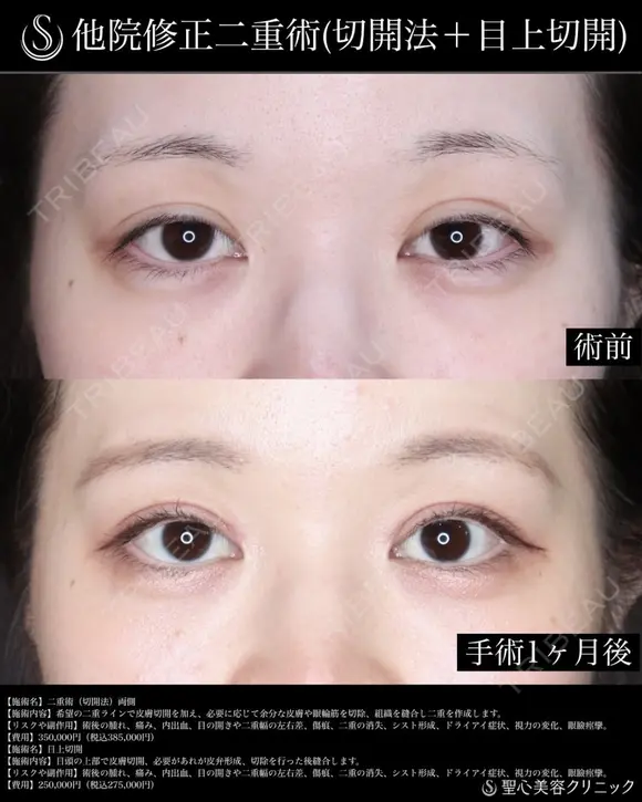 【30代女性・1か月後】二重術（切開法）_両側＋目上切開 30日後 メイン用