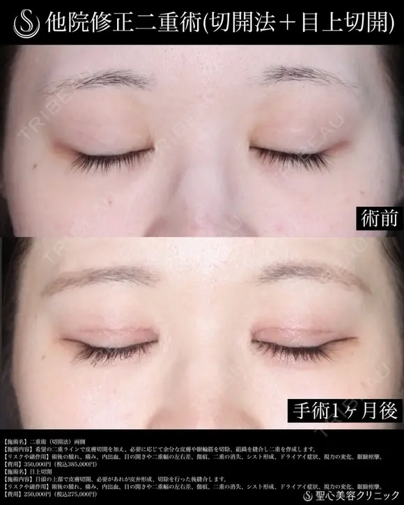 【30代女性・1か月後】二重術（切開法）_両側＋目上切開 30日後 メイン用