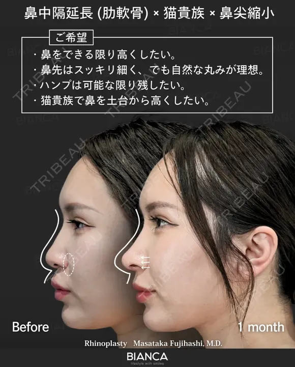 肋軟骨鼻フル after画像 メイン用