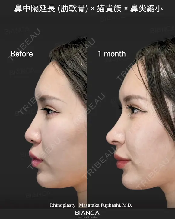 肋軟骨鼻フル after画像 メイン用