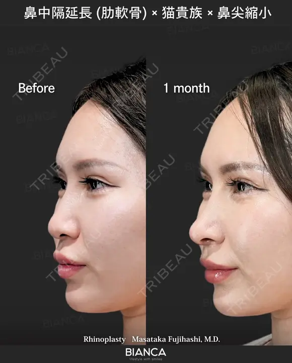 肋軟骨鼻フル after画像 メイン用