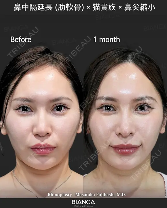 肋軟骨鼻フル after画像 メイン用