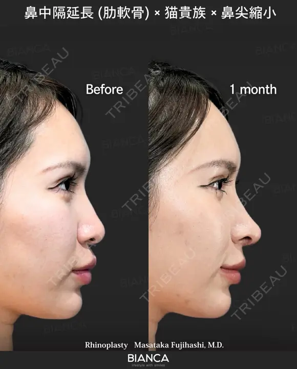 肋軟骨鼻フル after画像 メイン用