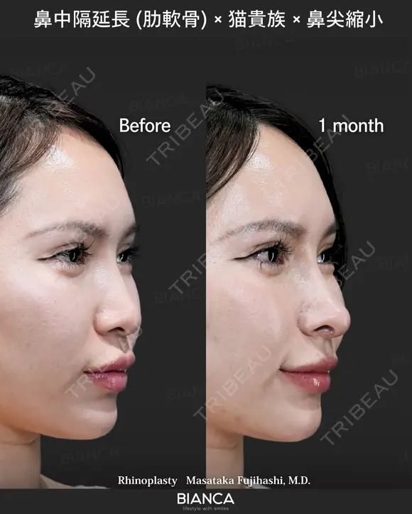 肋軟骨鼻フル after画像 メイン用