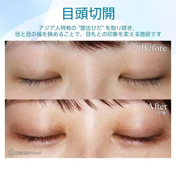 【20代女性・大人っぽい平行型の二重に】目頭切開 before画像 メイン用