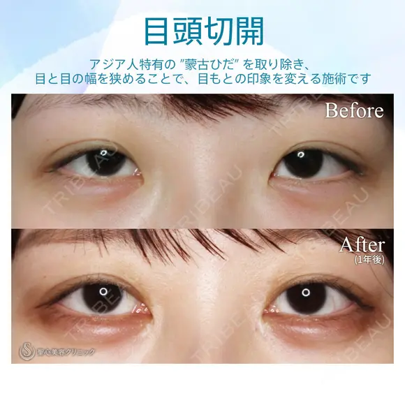 【20代女性・大人っぽい平行型の二重に】目頭切開 after画像 メイン用