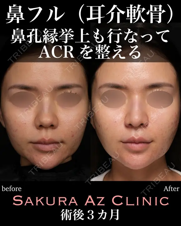 オーダーメイド鼻フル before画像 メイン用
