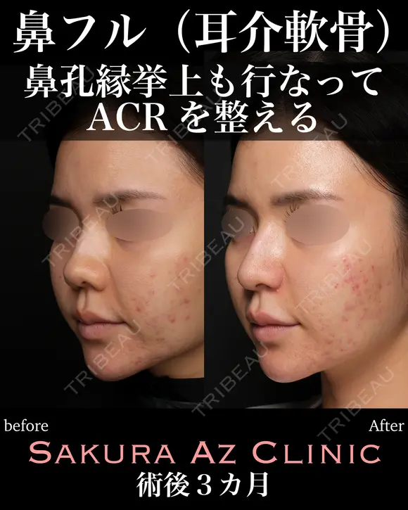 オーダーメイド鼻フル after画像 メイン用