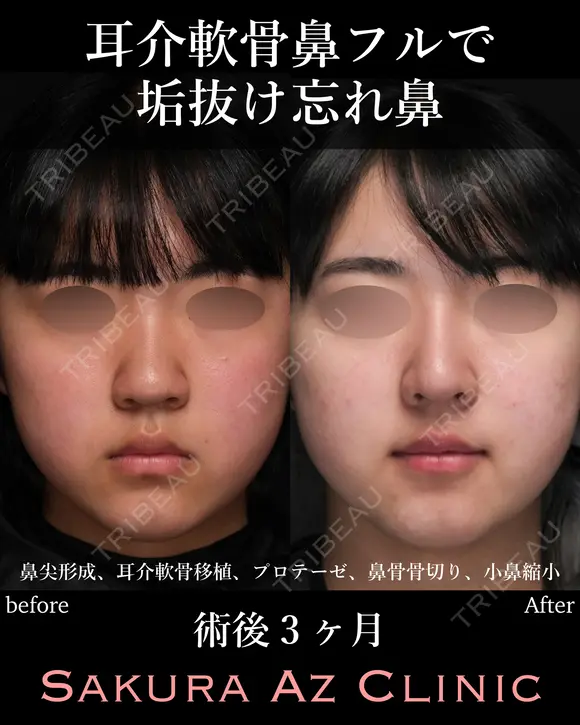 オーダーメイド鼻フル before画像 メイン用